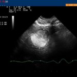 Präcardialer Tumor