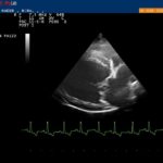 Parasternaler Herzschnitt rechts